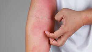 “¿Qué es la dermatitis atópica?